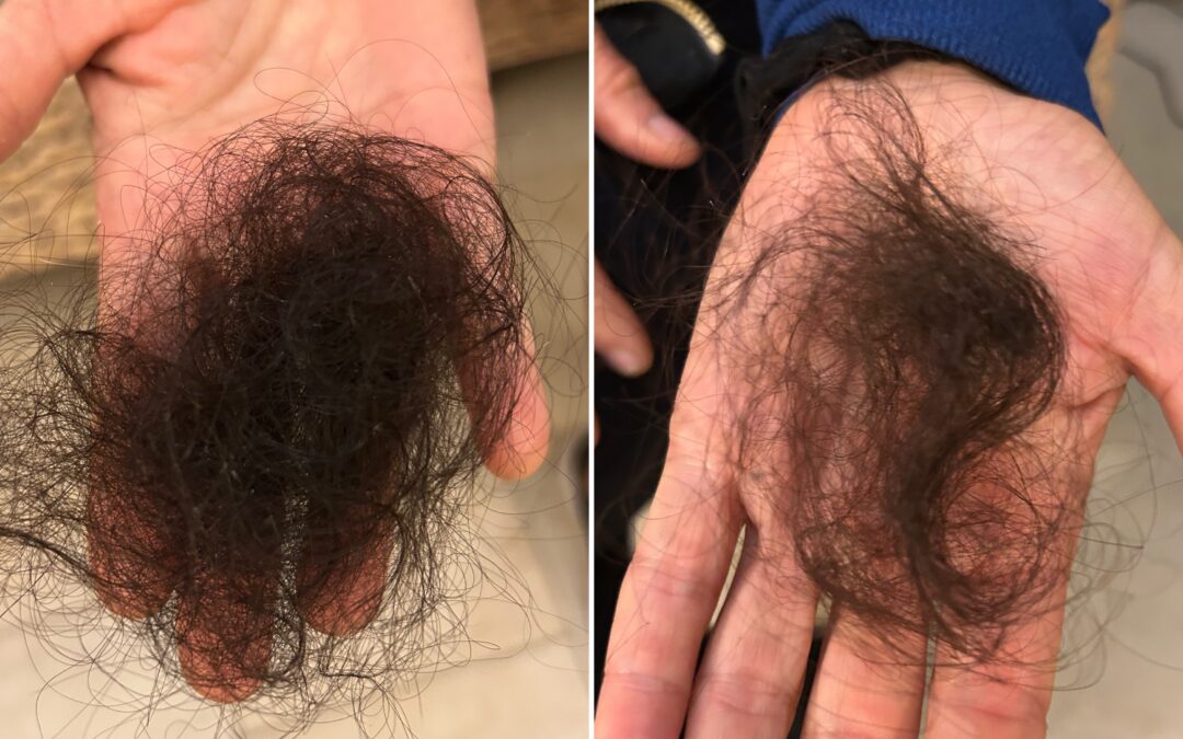 Why Is My Hair Falling Out? Understanding Sudden Hair Loss