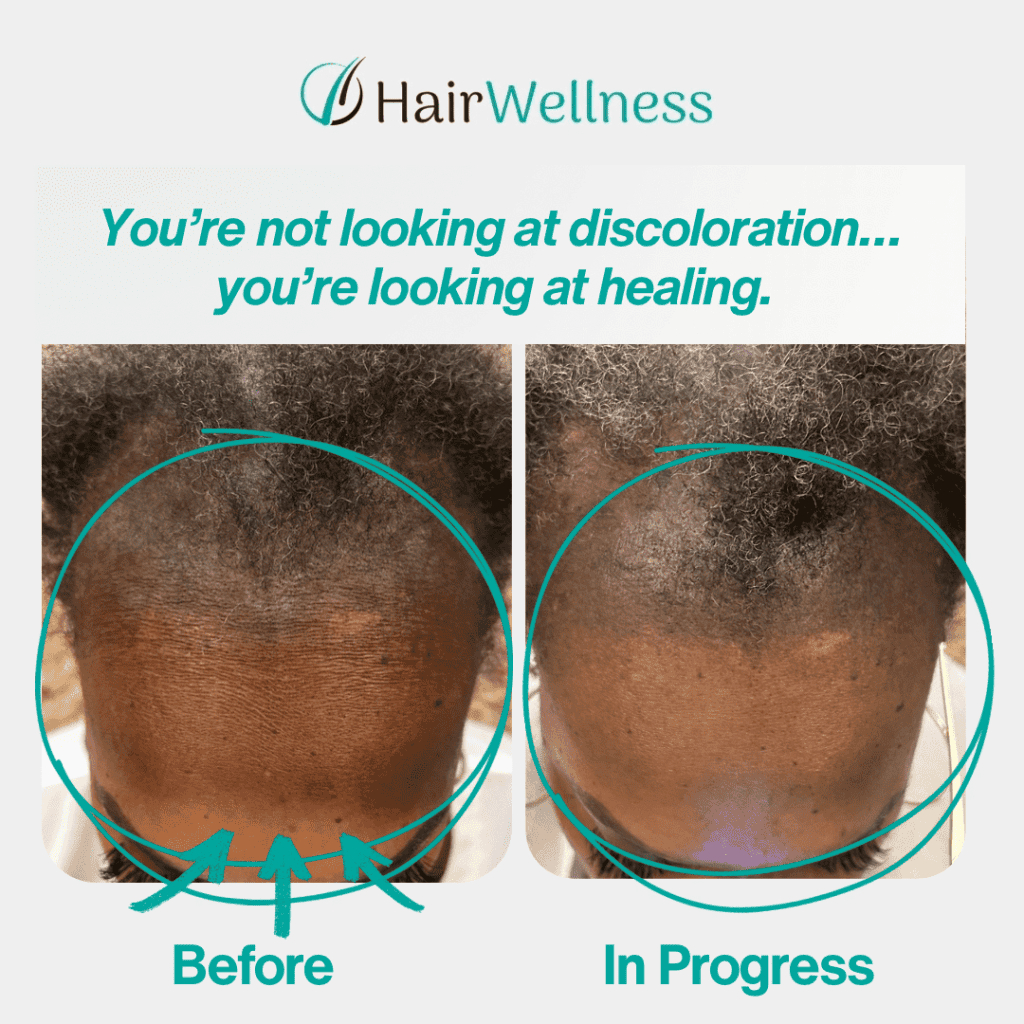 Scalp hyperpigmentation in CCCA
