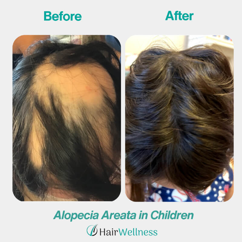 Alopecia Areata in Children Hair Wellness