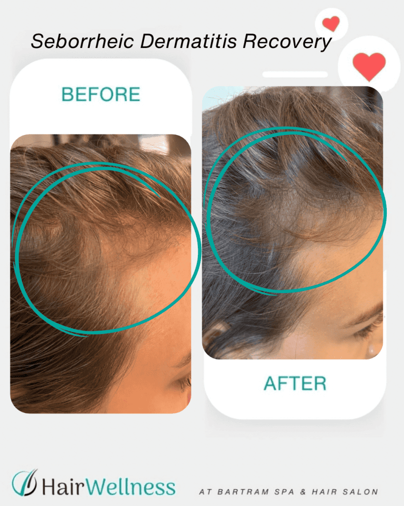 Common causes of hair thinning