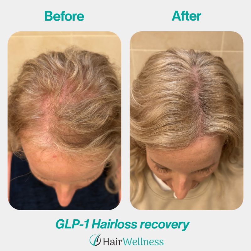GPL-1 Hairloss Recovery Hair Wellness
