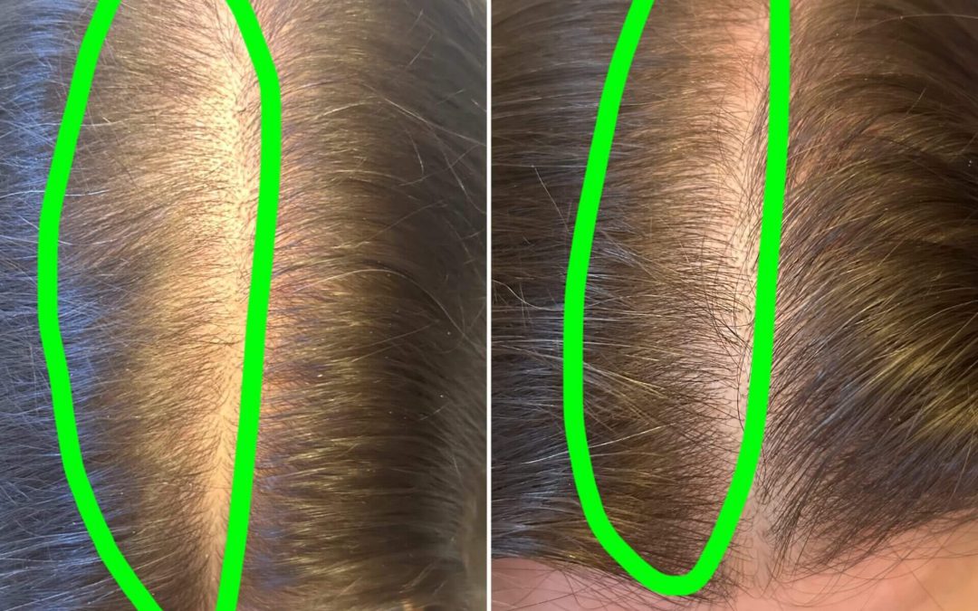 Why Is My Hair Shedding After Starting Weight Loss or a New Diet?