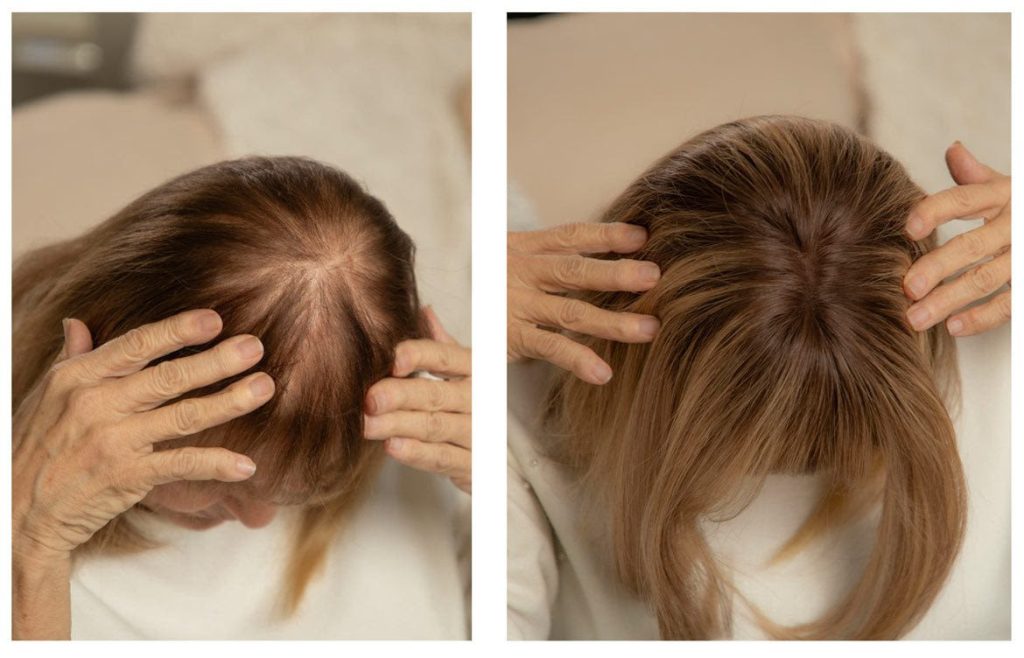 Hormonal hair loss in women