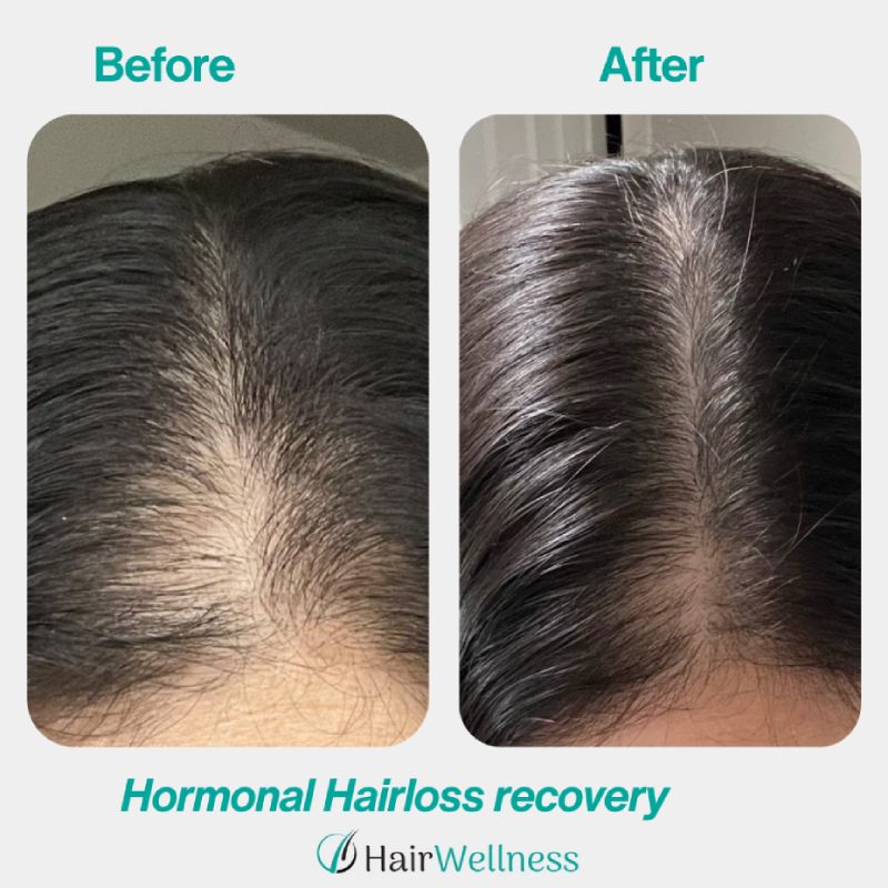 Hormonal Hairloss Recovery Hair Wellness