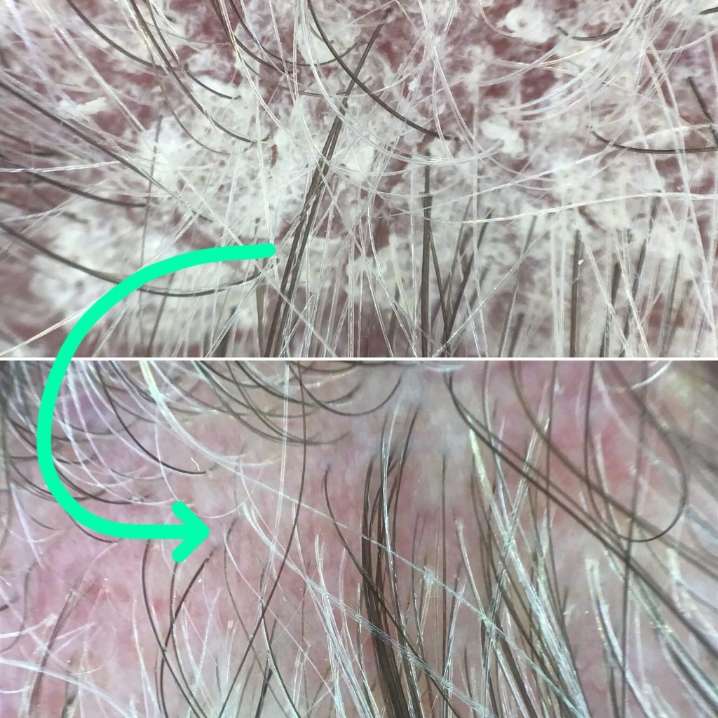 Itchy scalp and dandruff symptoms