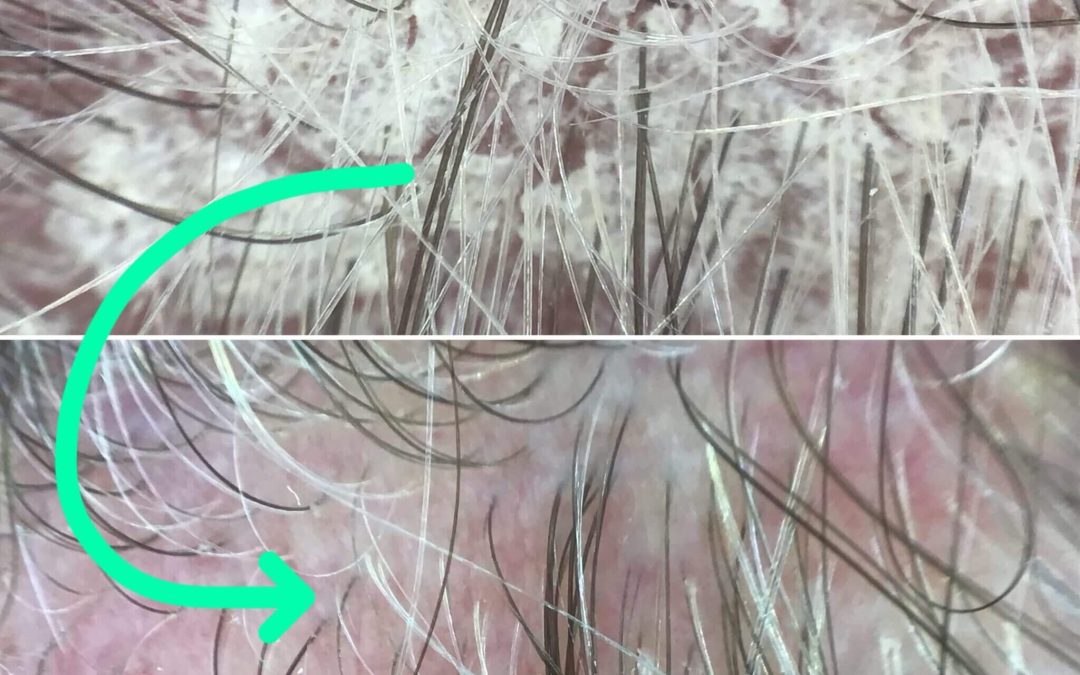 Why Is My Scalp Itchy or Flaky? Understanding Dandruff, Seborrheic Dermatitis, and Scalp Psoriasis