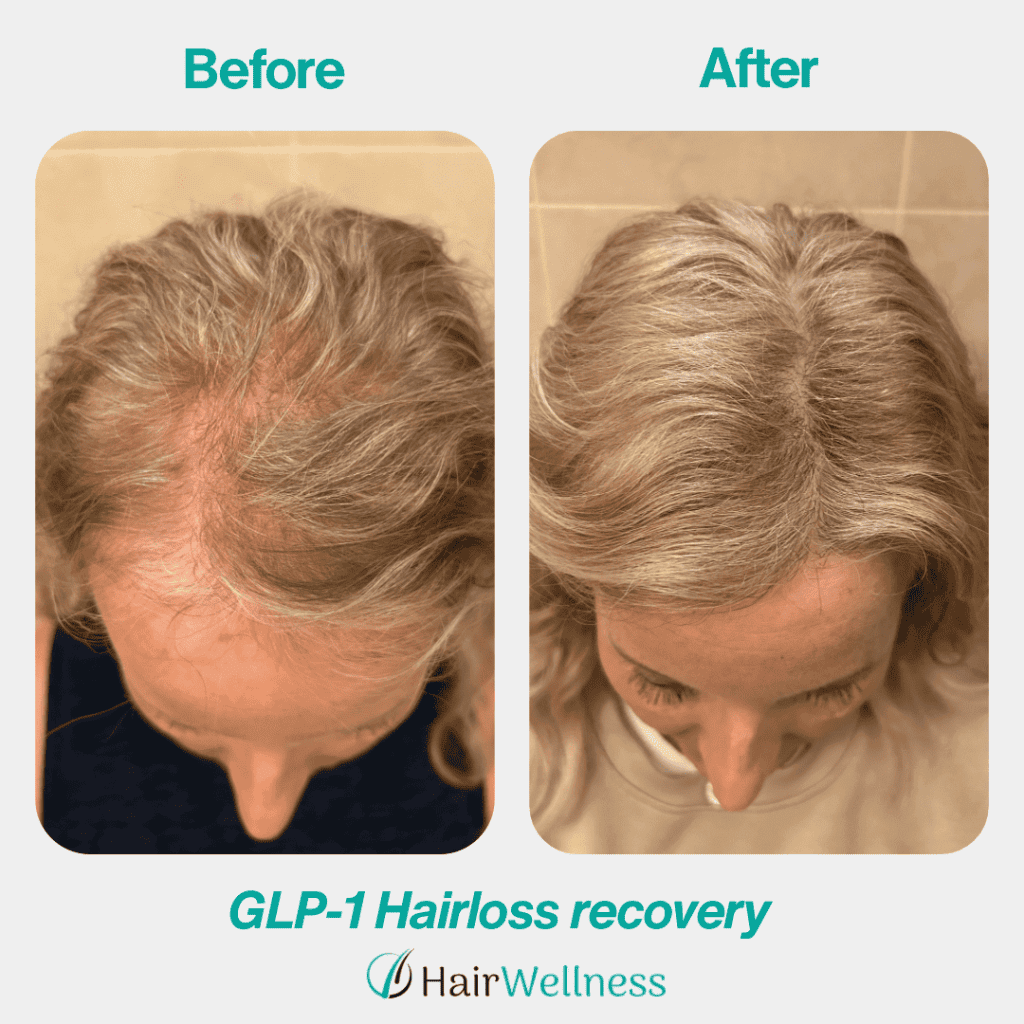 Hair shedding associated with Ozempic