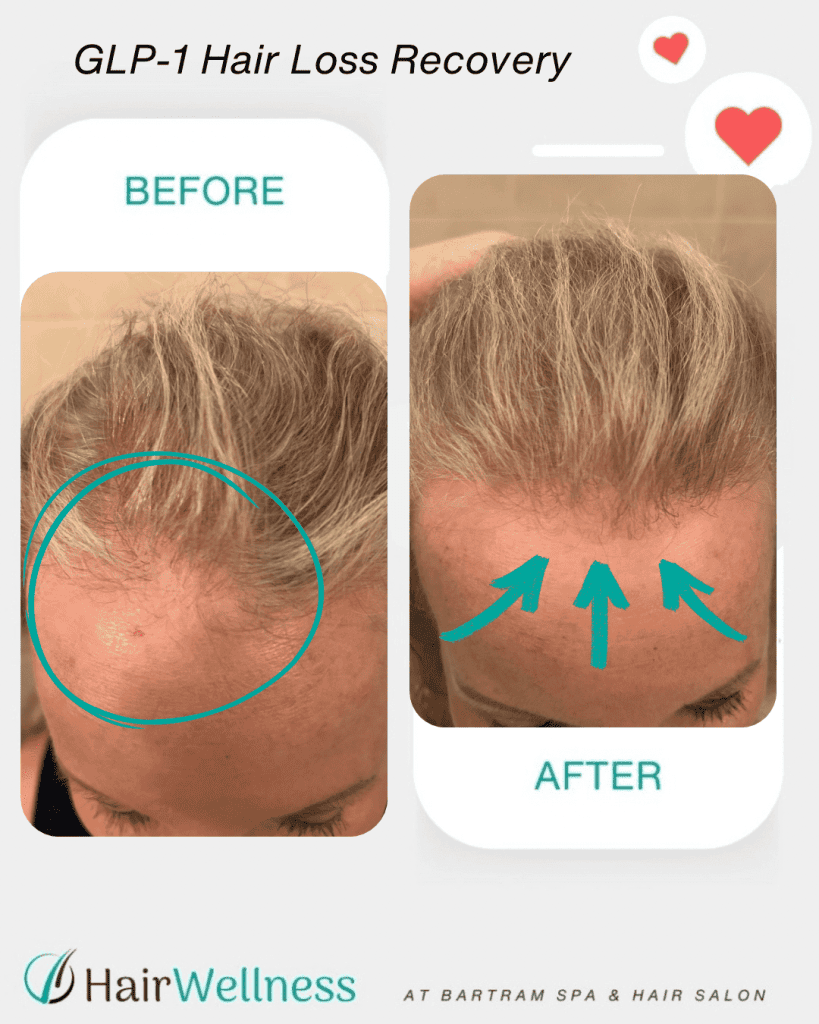 Hair shedding with GLP-1 medications