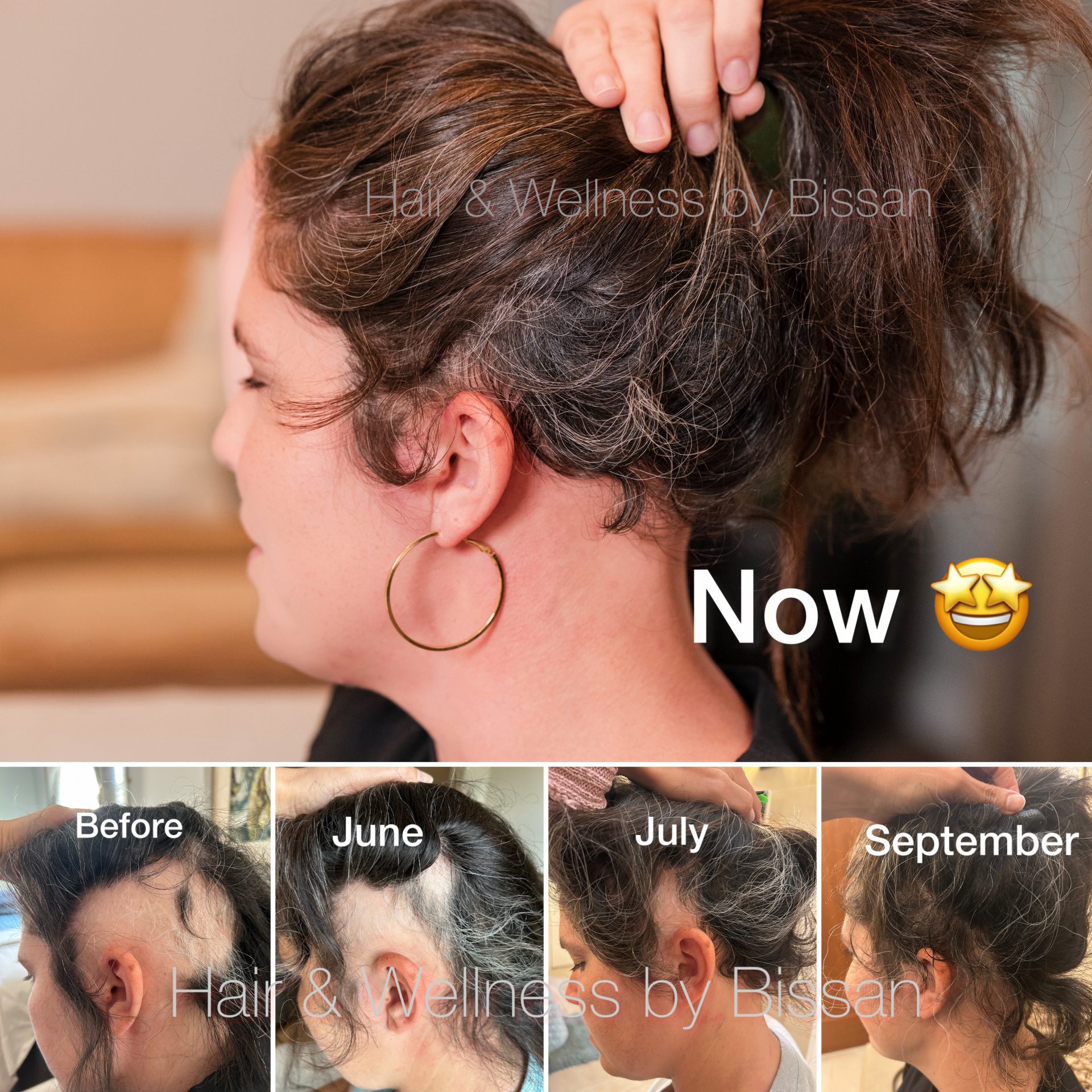 Client hair restoration progress collage