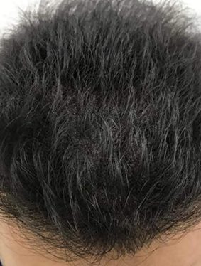 Scalp micropigmentation after results