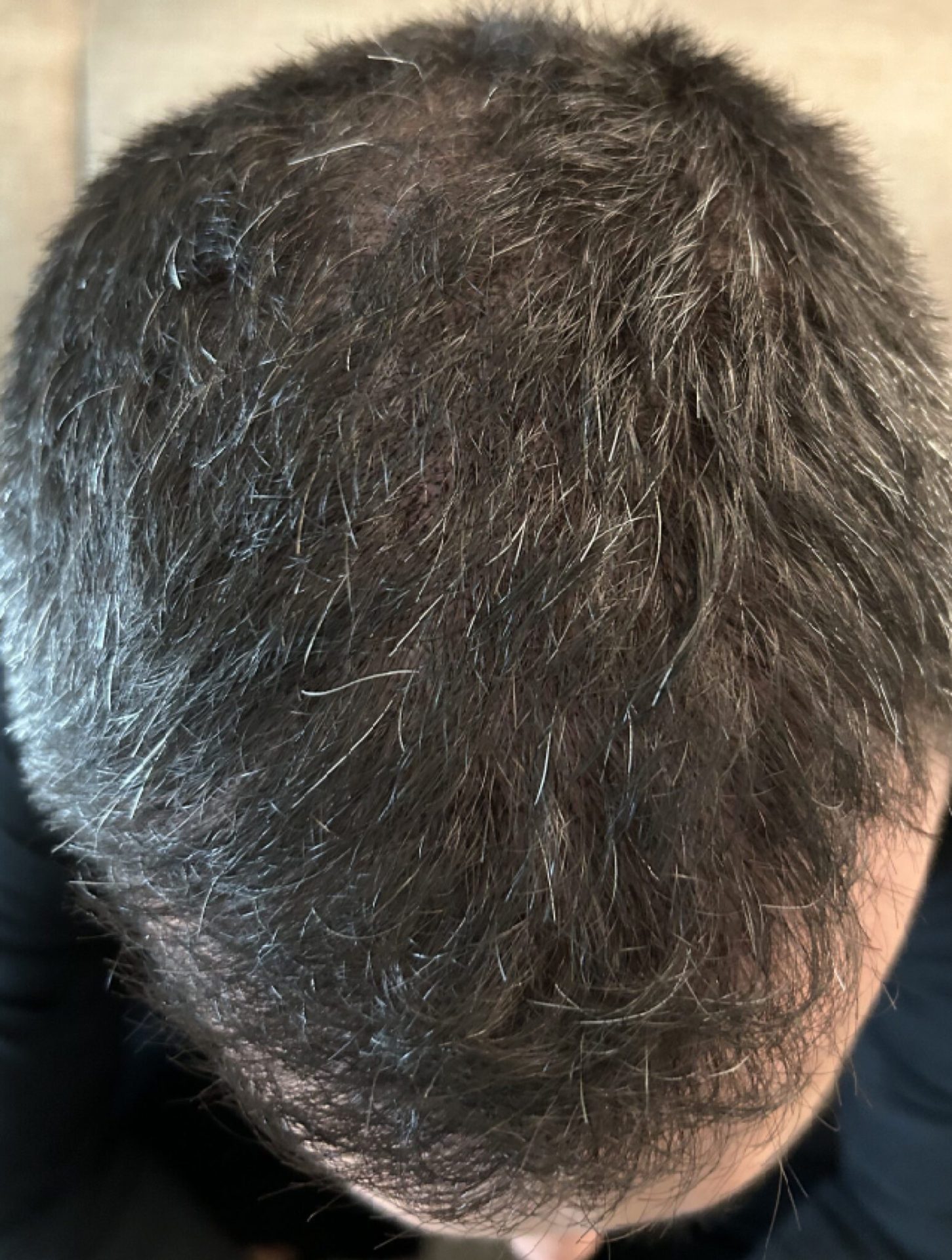 Hairline restored with scalp micropigmentation