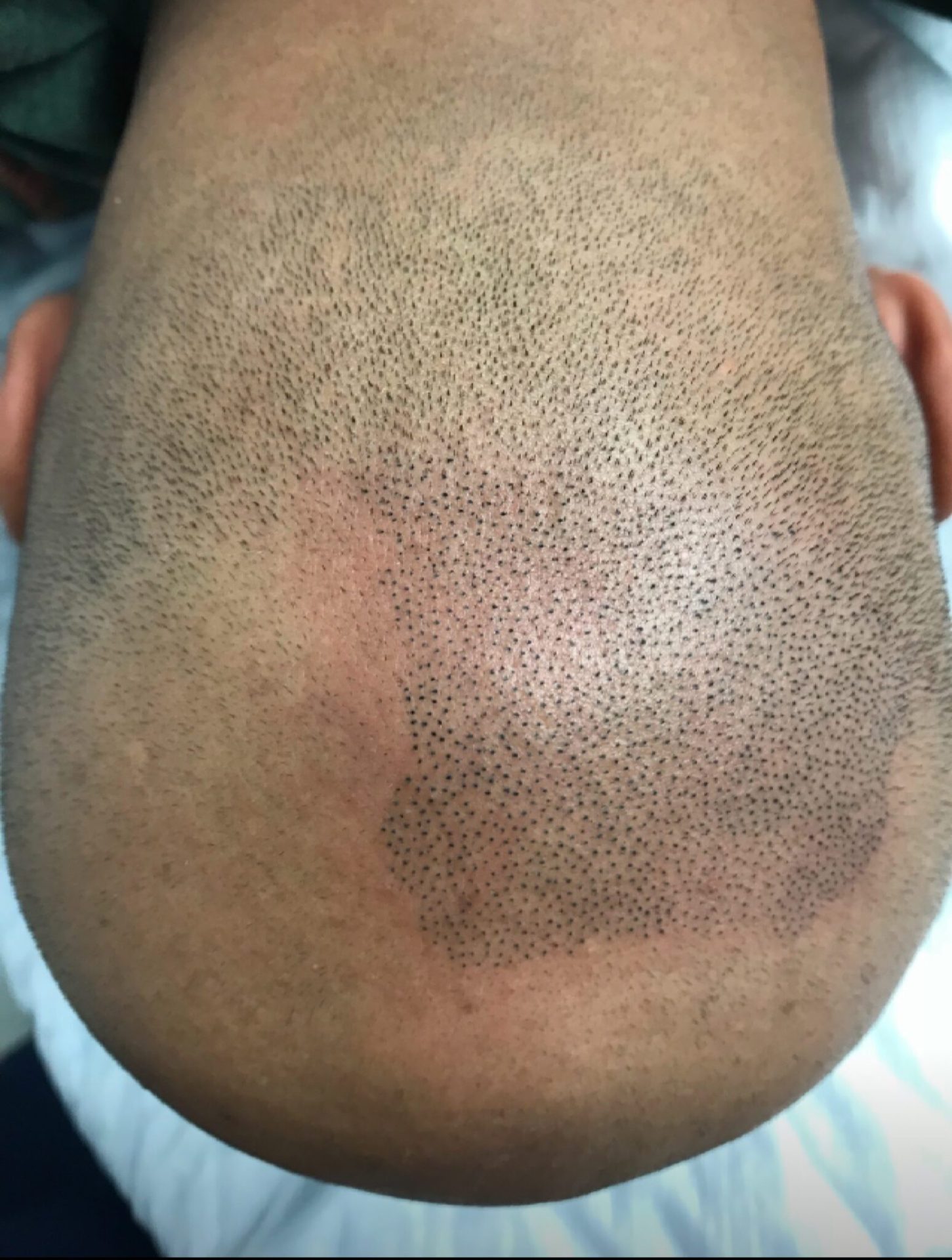 Improved scalp density after SMP