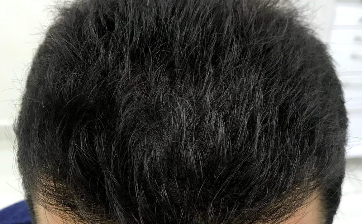 Fuller appearance after scalp micropigmentation