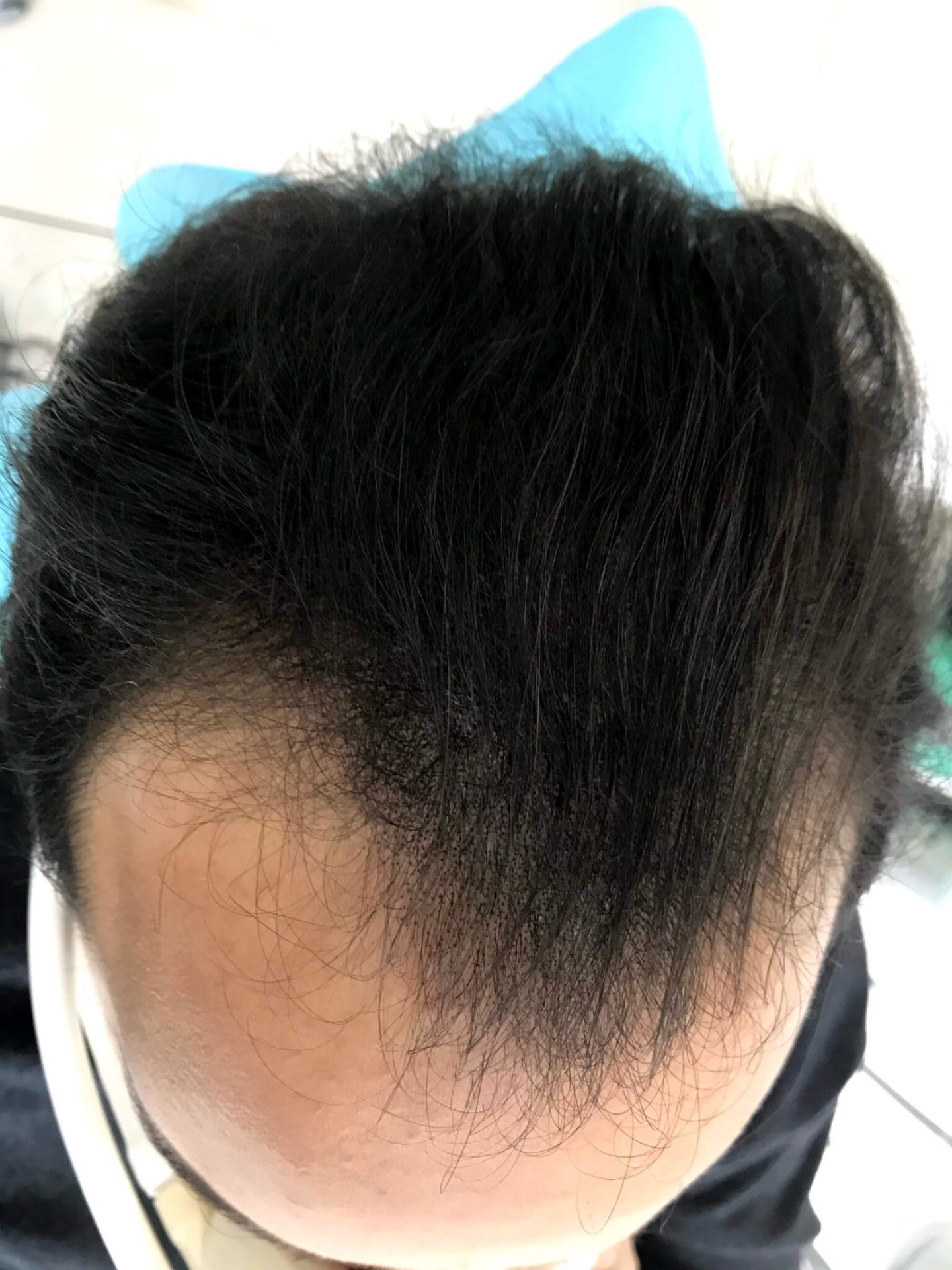 Non-surgical hair restoration results