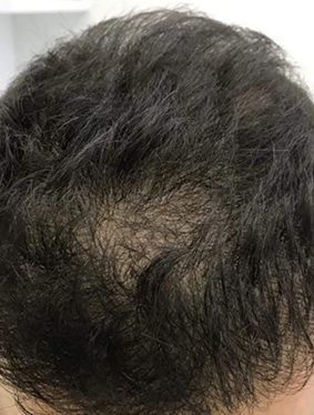 Scalp micropigmentation before results