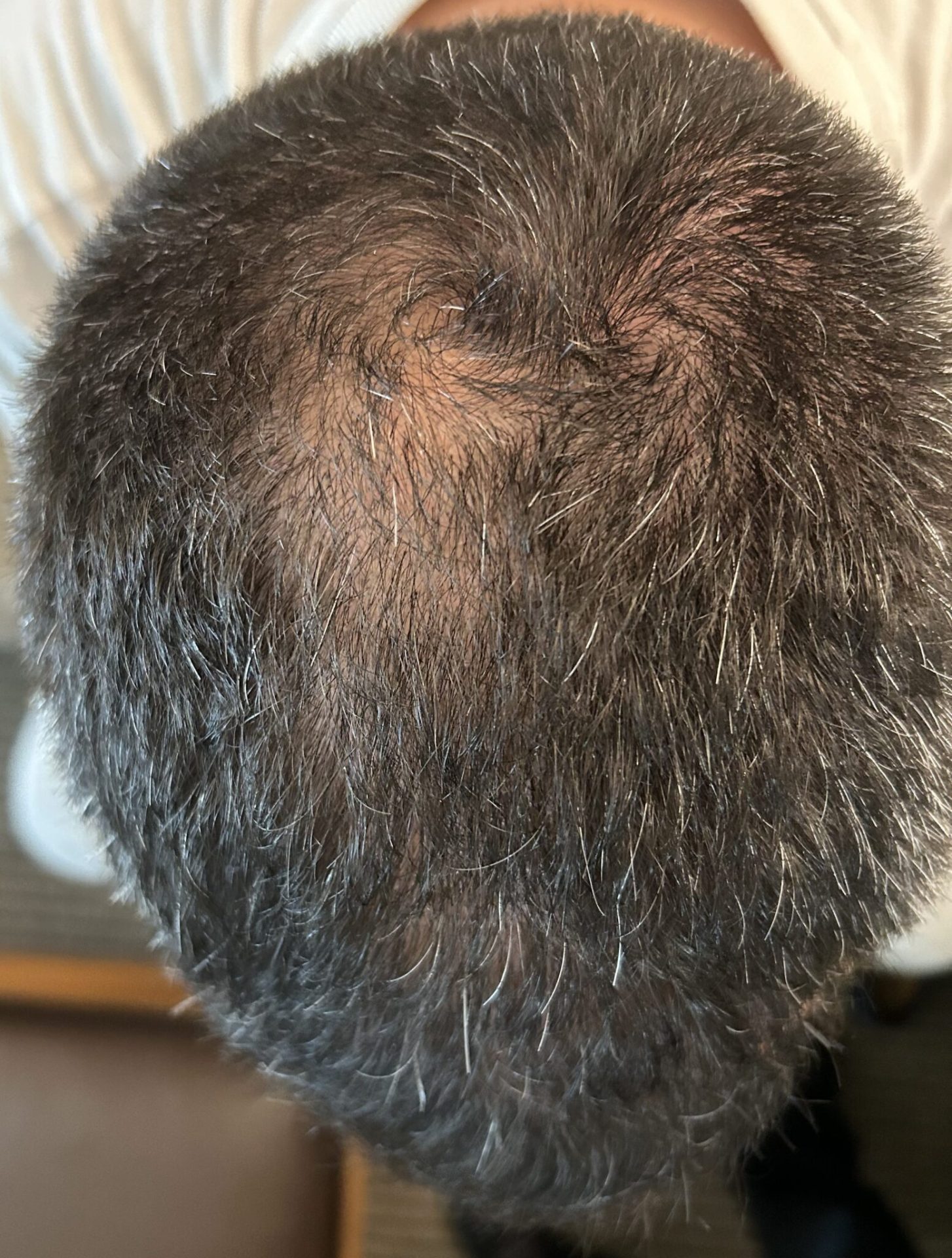 Before hairline restoration with SMP