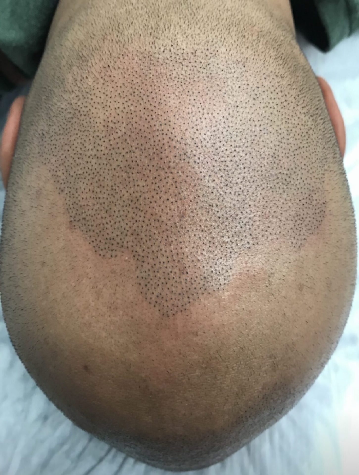Before scalp density enhancement