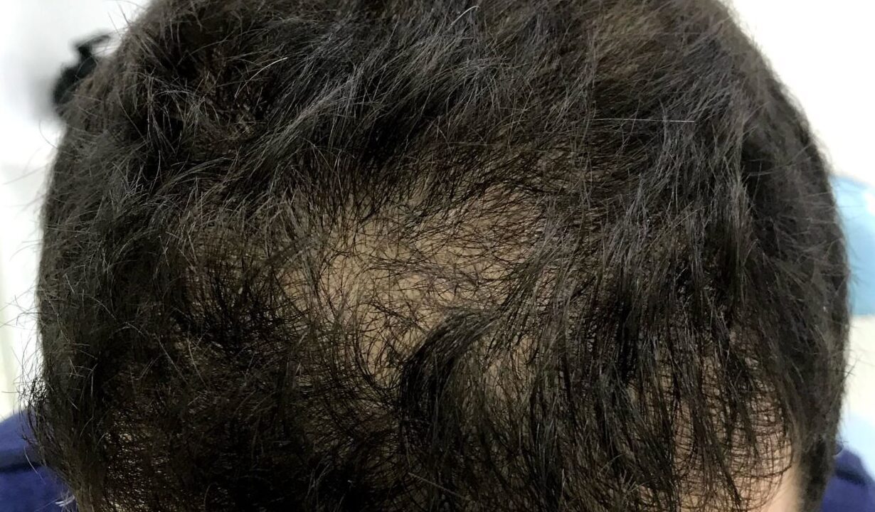 Before SMP for thinning hair