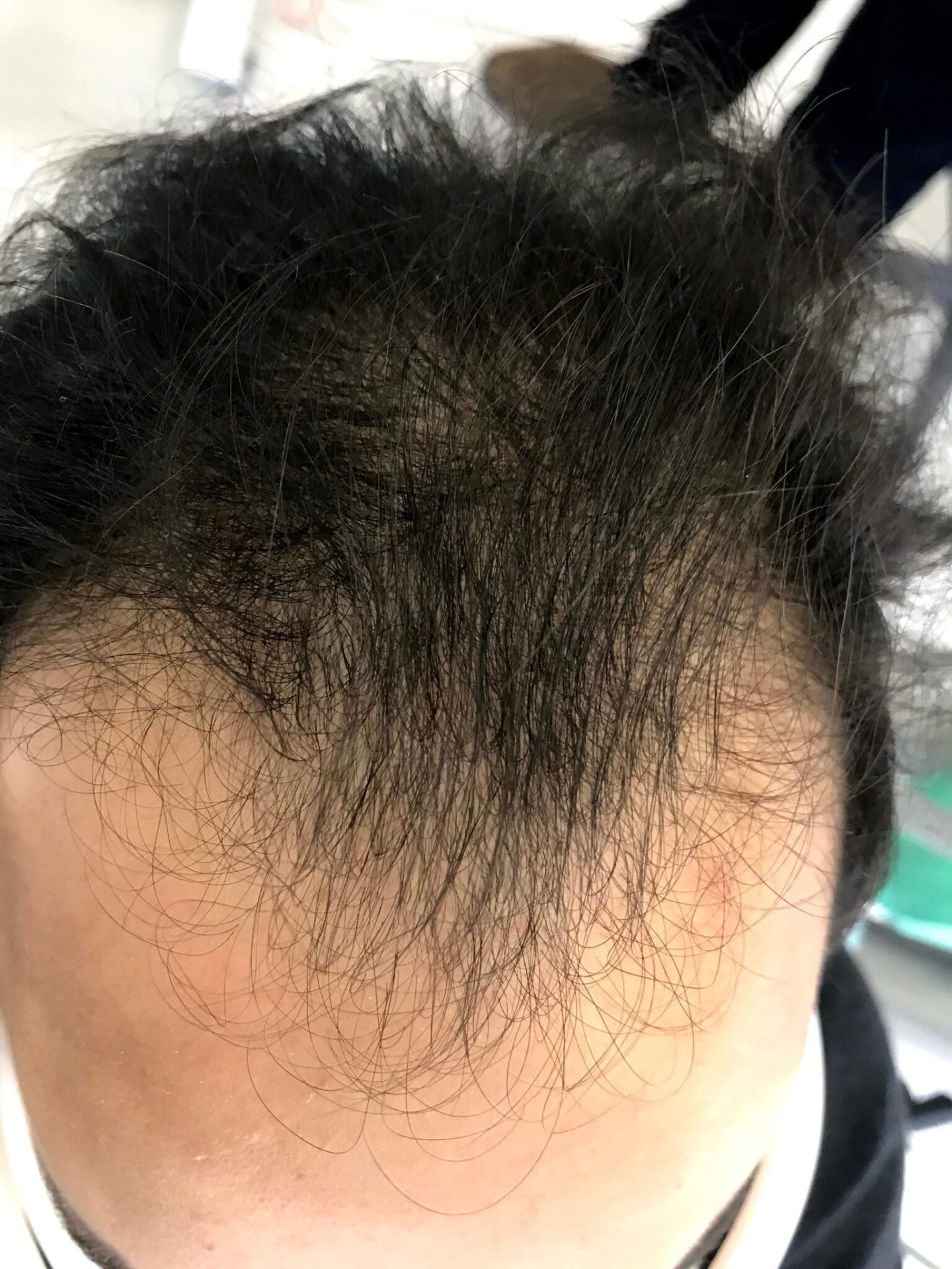 Before non-surgical hair restoration