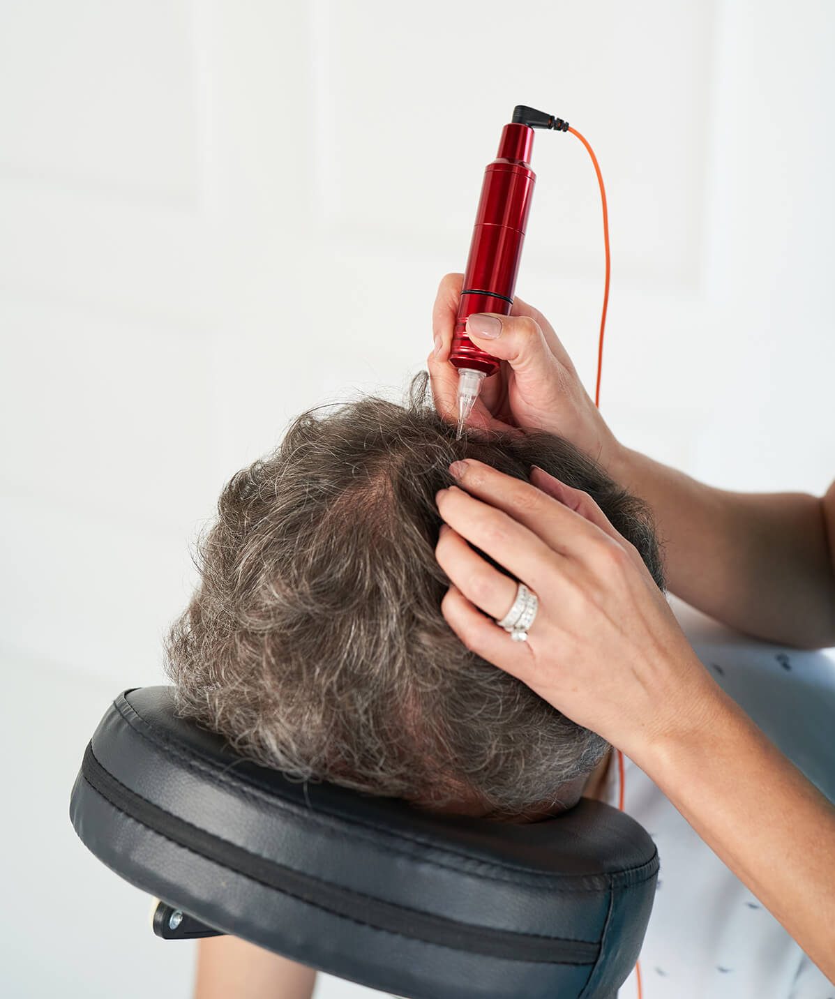 scalp-micropigmentation-procedure Scalp micropigmentation treatment procedure