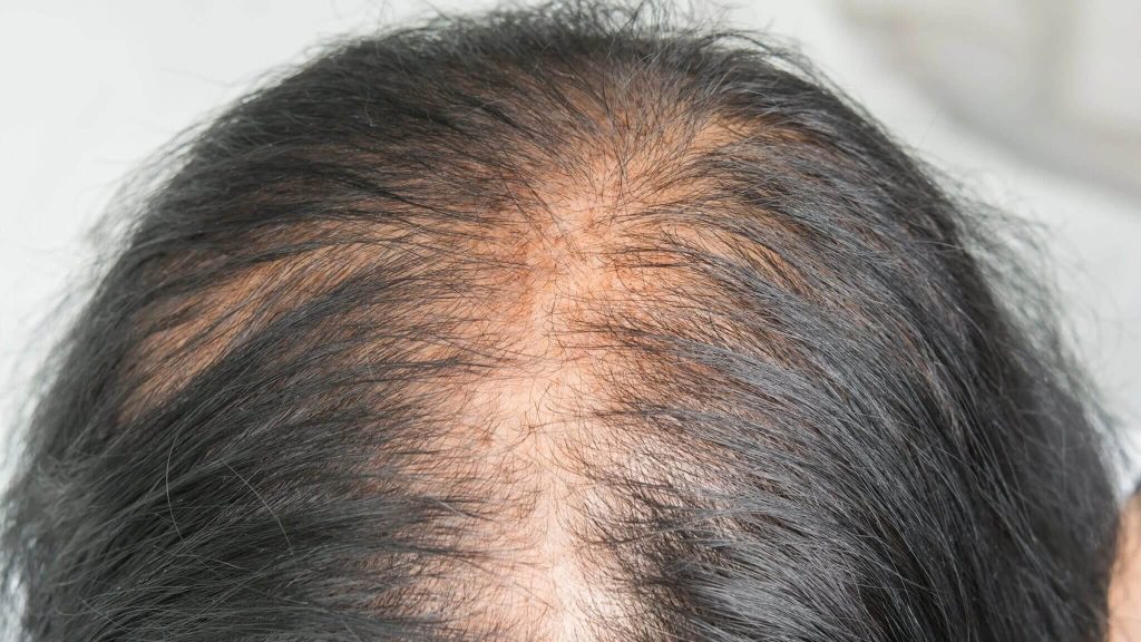 Seasonal hair shedding in spring