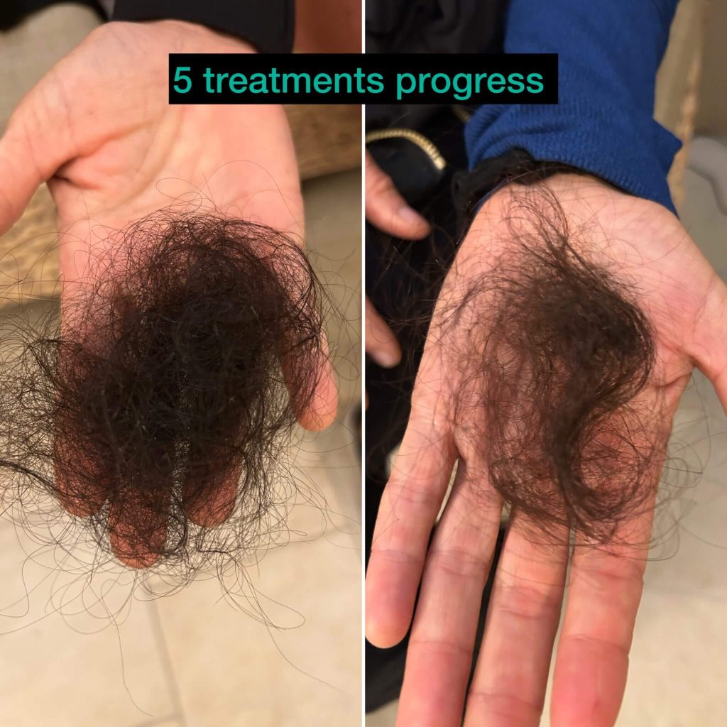 Understanding sudden hair loss