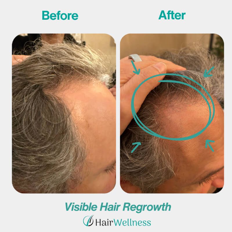 Visible Hair Regrowth Hair Wellness