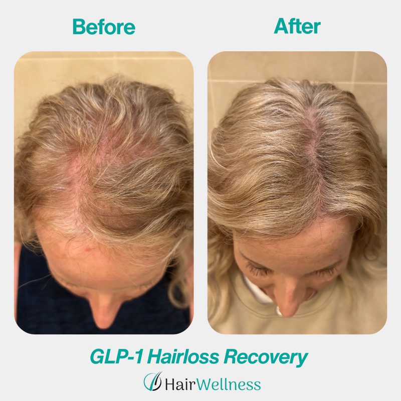 Telogen effluvium treatment result