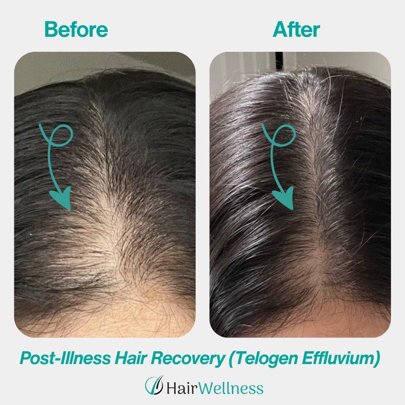 Hair restoration treatment result